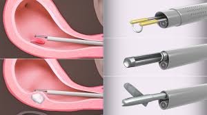 HYSTEROSCOPY